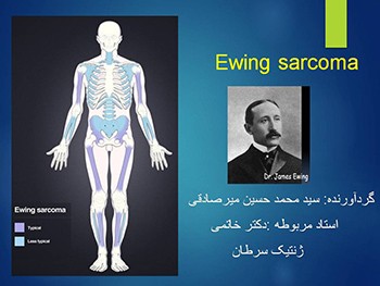 Ewing Sarcoma Family Tumors