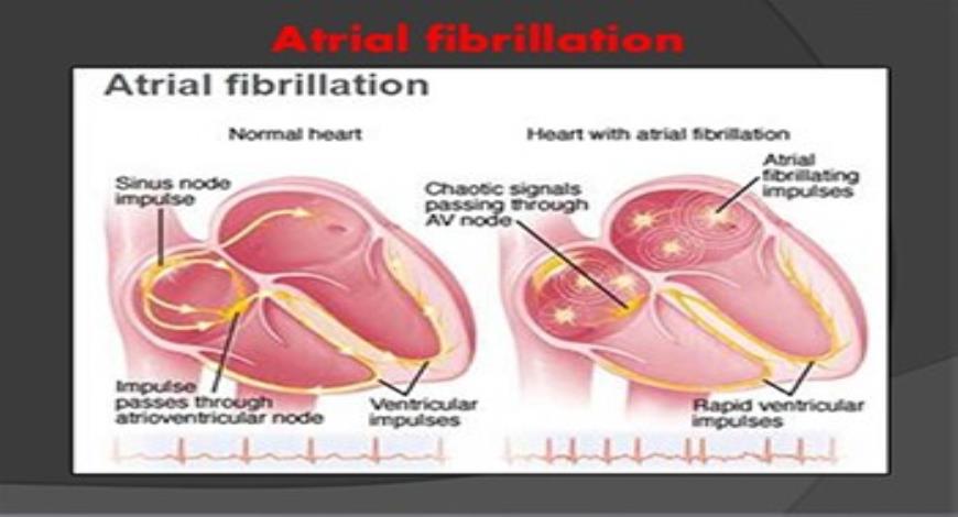 powerpoint presentation atrial fibrillation