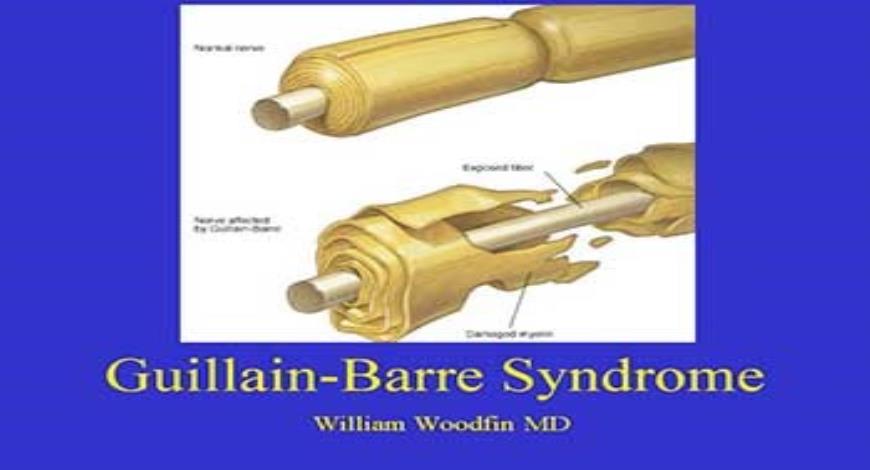 powerpoint presentation of guillain barre syndrome