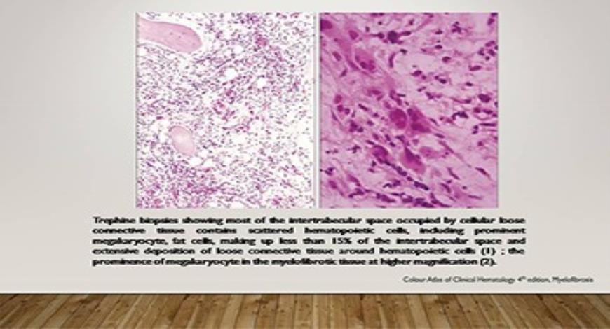 Download Free Medical Myelofibrosis PowerPoint Presentation
