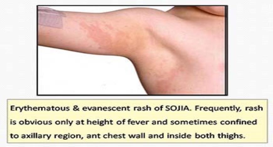 Download Free Medical Juvenile Idiopathic Arthritis (JIA) PowerPoint ...