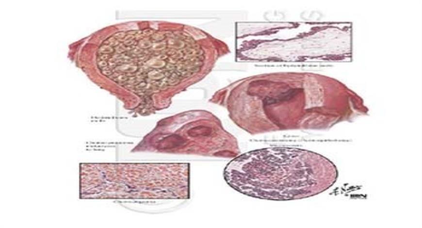 Download Free Medical Gestational Trophoblastic Disease (GTD ...