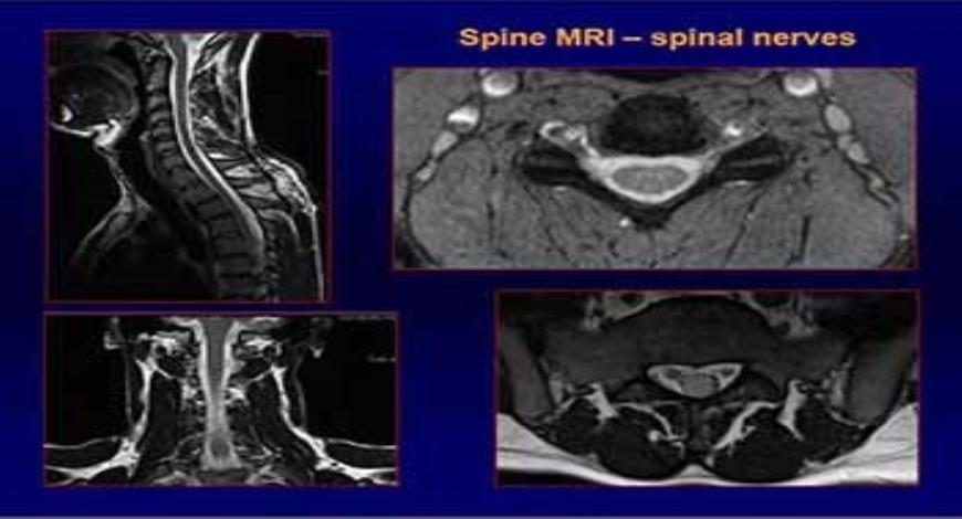 Download Free Medical MR IMAGING OF SPINE PowerPoint Presentation