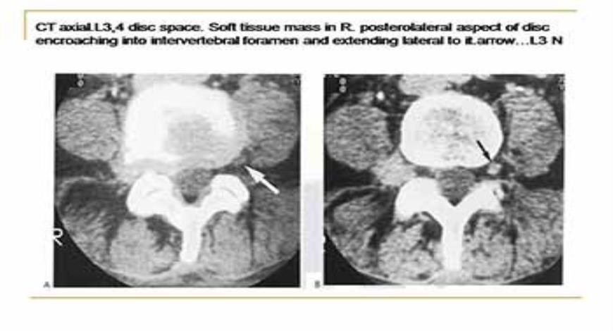 Download Free Medical Disc prolapse and degenerative changes PowerPoint ...