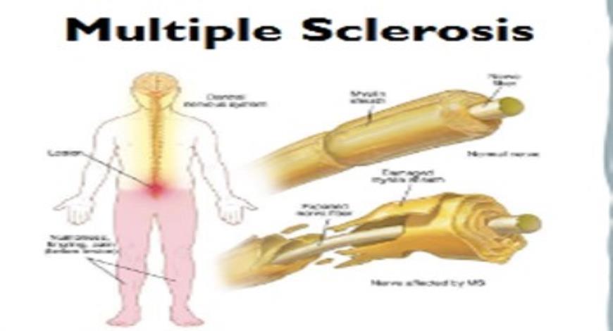 Download Medical Notes on Multiple Sclerosis