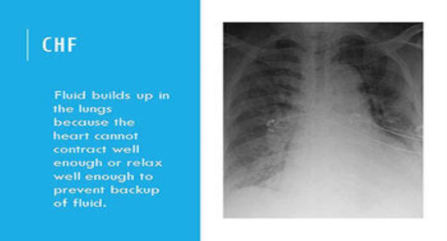 Download Free Medical Heart Failure PowerPoint Presentation