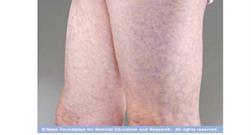 Download Free Medical Venous Thromboembolism (VE)- Deep Vein Thrombosis ...