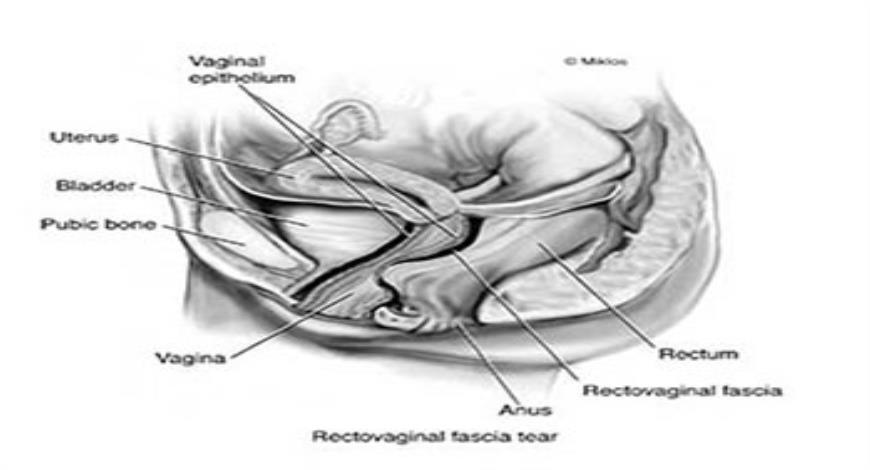 Download Free Medical Pelvic Organ Prolapse PowerPoint Presentation