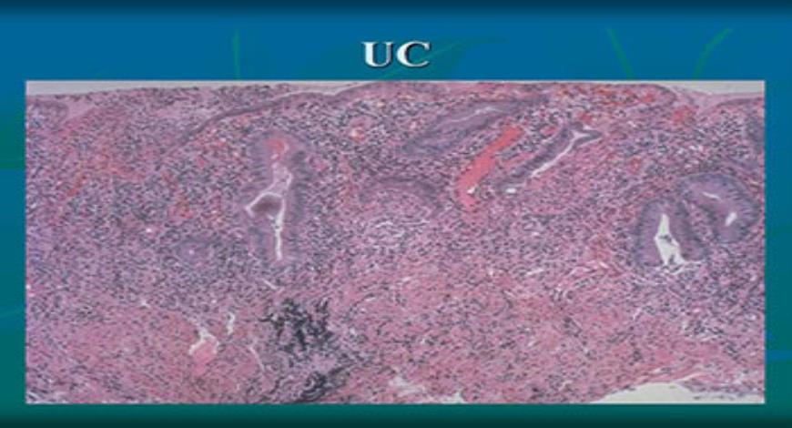 Download Free Medical Inflammatory Bowel Disease PowerPoint Presentation