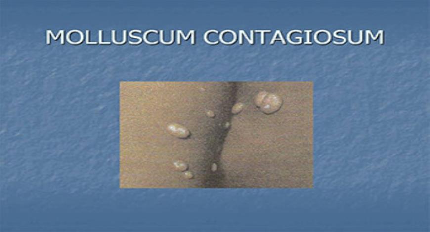 Download Free Medical Common Childhood Infections and Rashes PowerPoint ...