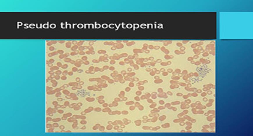Download Free Medical Bleeding disorders thrombocytopenia