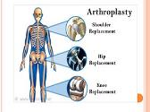 Arthroplasty