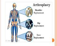 Arthroplasty PowerPoint Presentation