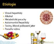 Cirhoza Jater PowerPoint Presentation