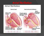 Atrial Fibrillartion PowerPoint Presentation
