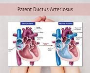 Prostaglandin E1 PowerPoint Presentation