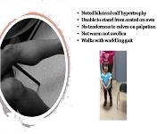 Approach to Abnormal Gait PowerPoint Presentation