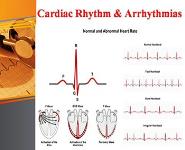 Antiarrhythmic drugs PowerPoint Presentation Notes