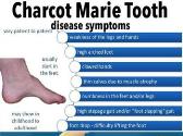 Charcot Marie Tooth