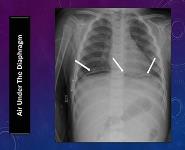 Radiographic Signs of Gastrointestinal PowerPoint Presentation