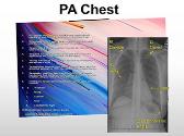 Chest Evaluation and Chest X-ray 2 Views
