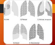 HRCT PowerPoint Presentation