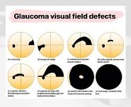 GLAUCOMA PowerPoint Presentation