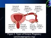 Risk of Ectopic Pregnancy