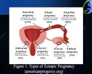 Risk of Ectopic Pregnancy PowerPoint Presentation