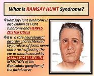 Ramsay Hunt syndrome PowerPoint Presentation