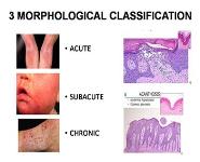 ECZEMA PowerPoint Presentation