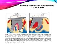 Carranza Occlusal Trauma PowerPoint Presentation