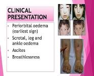 Nephrotic Syndrome PowerPoint Presentation
