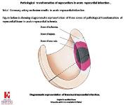ECG grammar part 2. section A ."Understanding the genesis of ECG changes in acute myocardial ischemi PowerPoint Presentation