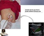 Diagnosis of Abdominal Ultrasound PowerPoint Presentation