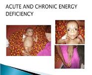 Deficiency Disorders PowerPoint Presentation Notes
