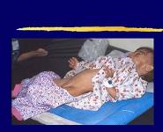 PROTEIN ENERGY MALNUTRITION PowerPoint Presentation Notes