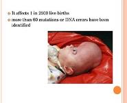 Craniosynostosis PowerPoint Presentation