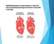Hypertension PowerPoint Presentation