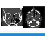Asthma Phenotypes PowerPoint Presentation