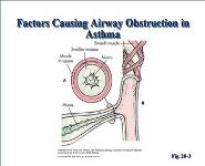 Asthma PowerPoint Presentation