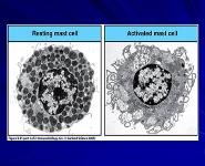 Acute Angioedema PowerPoint Presentation Notes