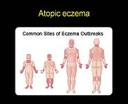 Atopic Eczema PowerPoint Presentation