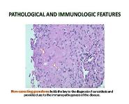 Ocular manifestations of sarcoidosis PowerPoint Presentation Notes