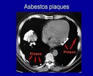 Occupational Lung Diseases PowerPoint Presentation