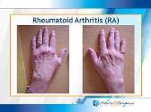 Rheumatoid Arthritis Treatment options
