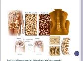 Osteoporosis