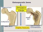 Age-related Bone Loss and Osteoporosis
