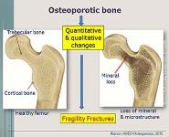 Age-related Bone Loss and Osteoporosis PowerPoint Presentation