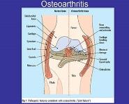 Treatment Options for Osteoarthritis PowerPoint Presentation Notes
